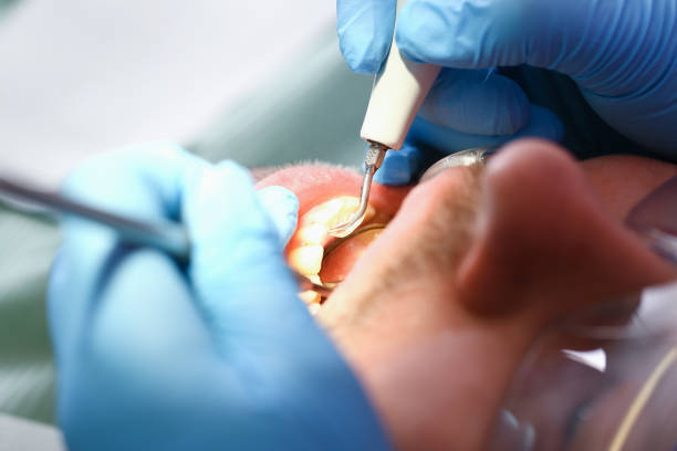 Best Emergency Dental Care for Broken or Chipped Teeth in Hampshire, IL