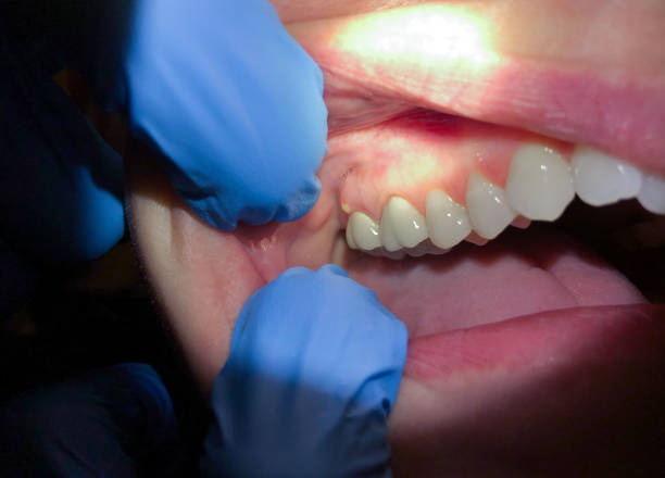 Best Emergency Treatment for Dental Infections or Abscesses in Hampshire, IL